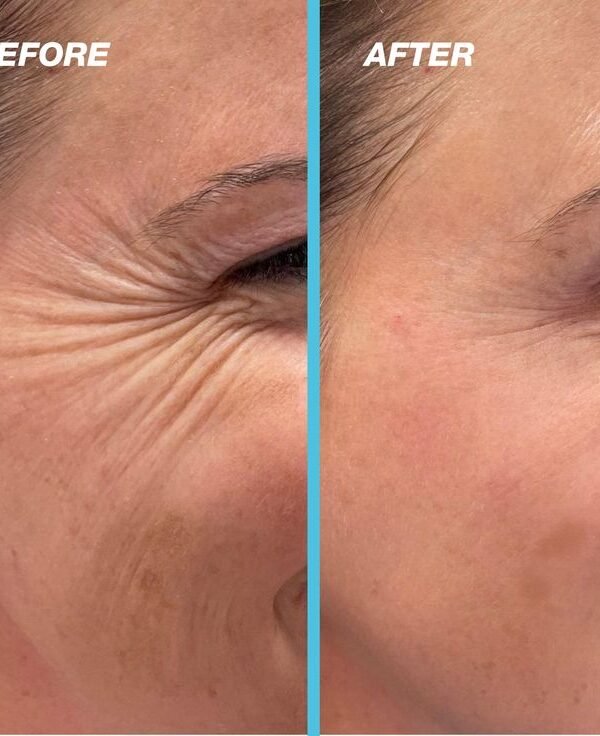 Before and after result