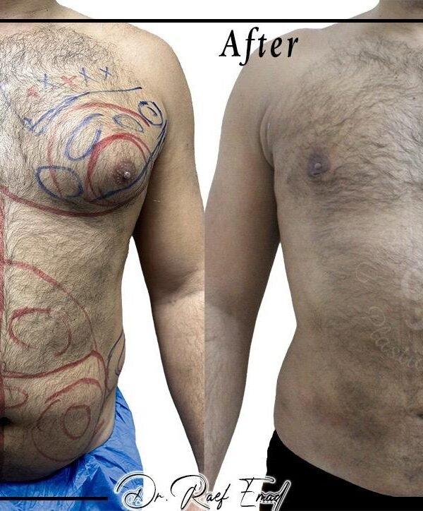 Before and after result
